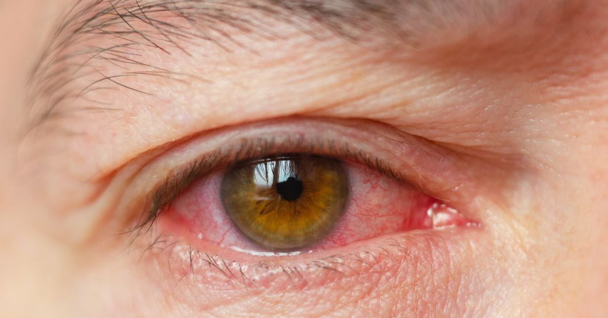 red eyes